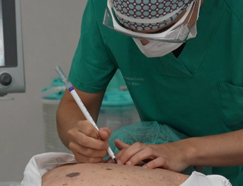 El Hospital Joan XXIII alerta sobre cinco falsos mitos que pueden aumentar el riesgo de cáncer de piel